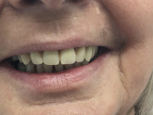 Dental Implants Newcastle Under Lyme