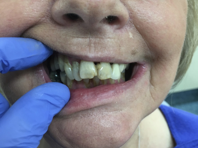 Dental Implants Newcastle Under Lyme