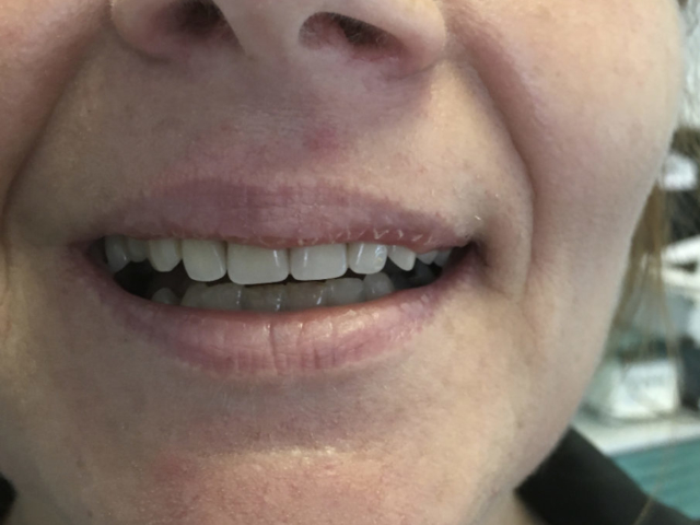 Dental Implants Newcastle Under Lyme