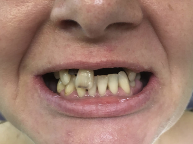 Dental Implants Newcastle Under Lyme